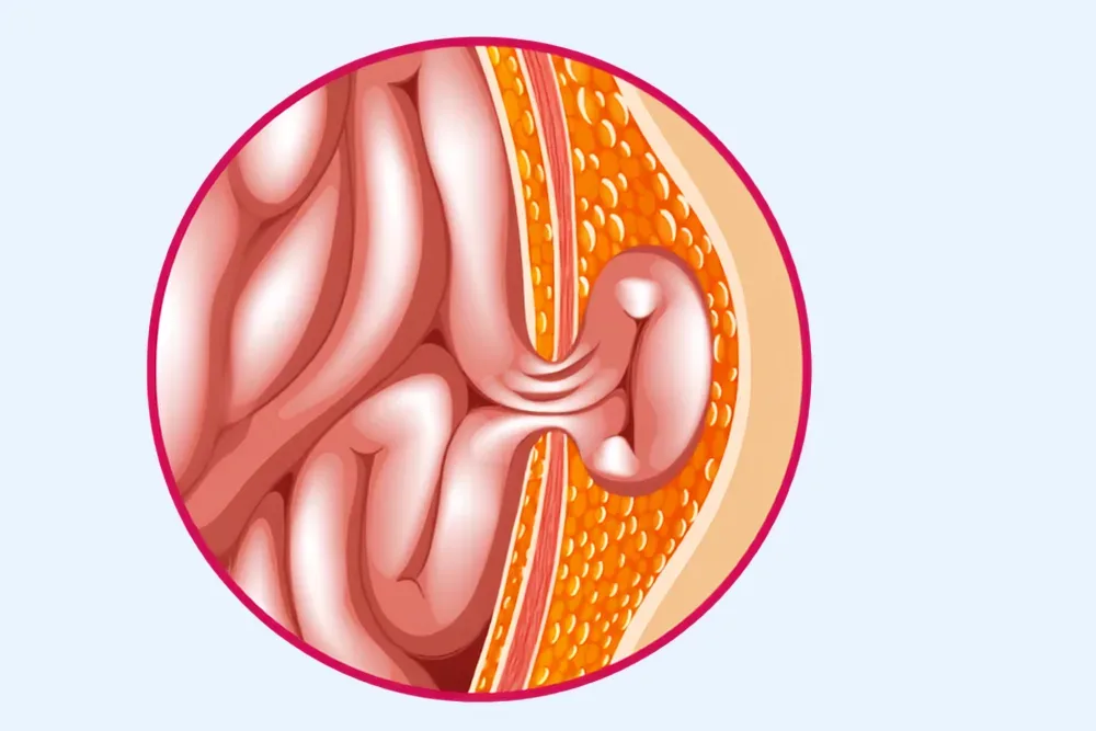 Manejo de hernias umbilicales en Veracruz